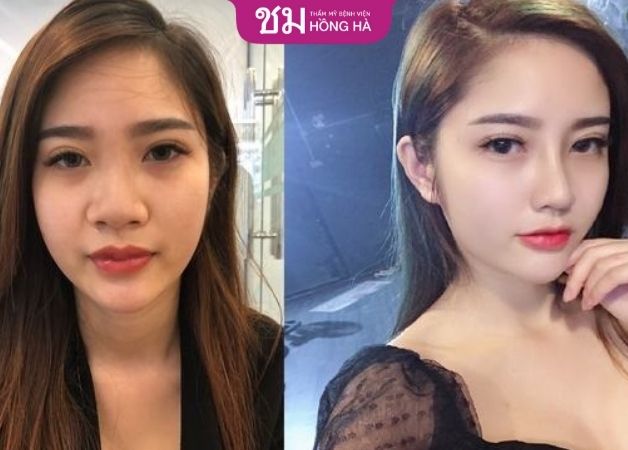 Cánh mũi nhỏ gọn khiến khuôn mặt thanh thoát và hài hòa