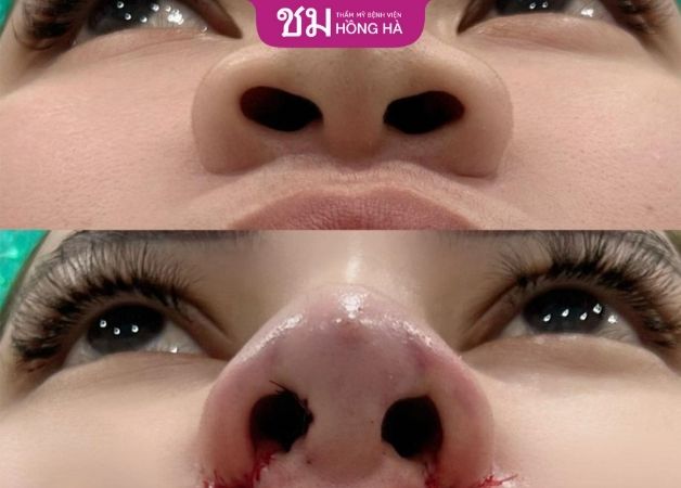 Hình ảnh trước sau của khách hàng khi thực hiện thu nhỏ cánh mũi tại Hồng Hà