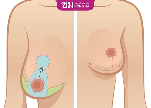 Phẫu thuật thu nhỏ vú phì đại giúp thu nhỏ ngực và cải thiện chảy xệ