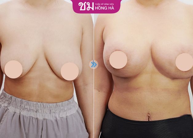 Hình ảnh trước và sau khi phẫu thuật thu nhỏ ngực phì đại