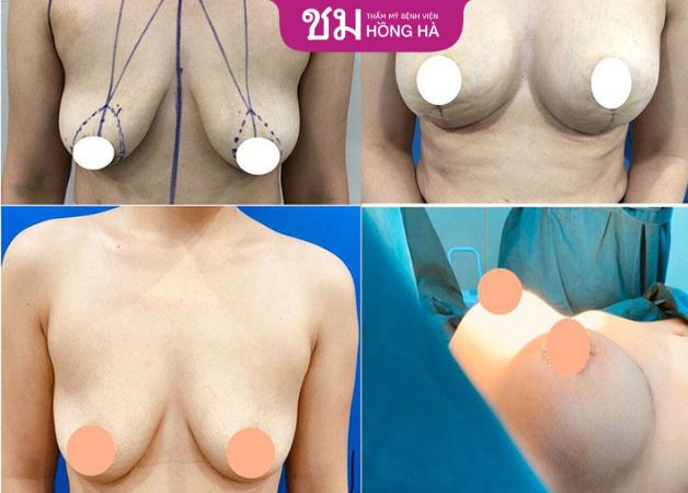 Vòng 1 thay đổi rõ rệt, tình trạng chảy xệ không còn nữa