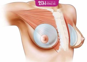 Tái tạo quầng núm vú nên thực hiện khi nào? Chi phí bao nhiêu