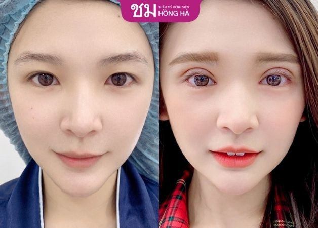 Khách hàng mắt một mí trở nên đẹp hơn với đôi mắt 2 mí rõ nét