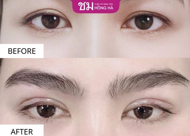 Hình ảnh trước sau của khách hàng khi thẩm mỹ mắt