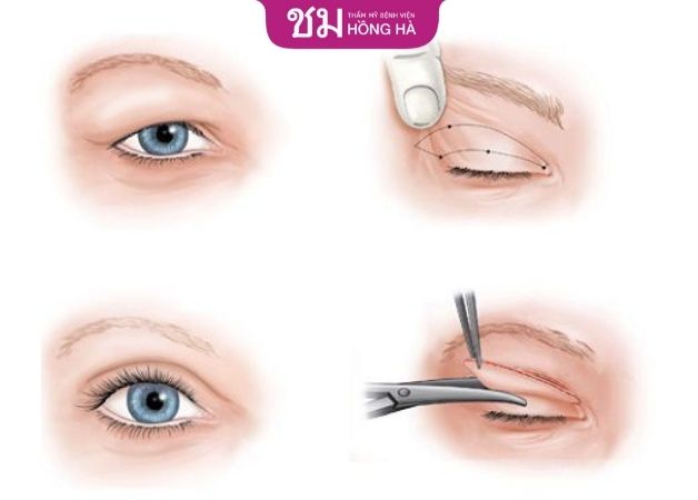 Phương pháp cắt mí mắt loại bỏ da và mỡ thừa