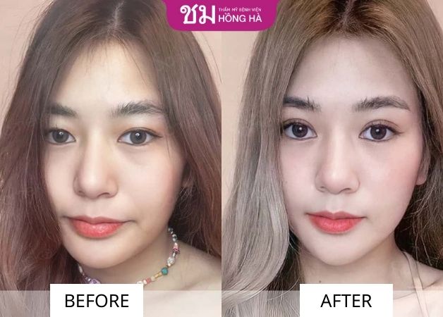 Chị Trang sau 2 tháng khi bấm mí mắt Thái Lan