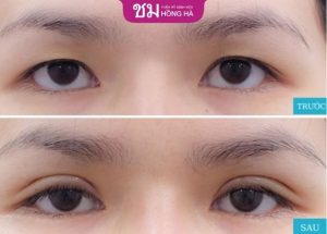 Bấm mí Thai Eyelid – Giải pháp thẩm mỹ mắt đẹp tự nhiên sau 60 phút