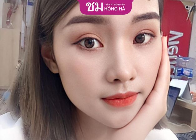 Thẩm mỹ cắt mí mắt tại Hồng Hà