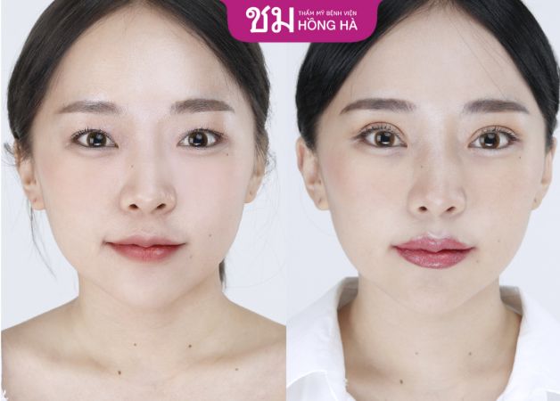 Khuôn mặt trông thu hút và ấn tượng hơn sau cắt mí