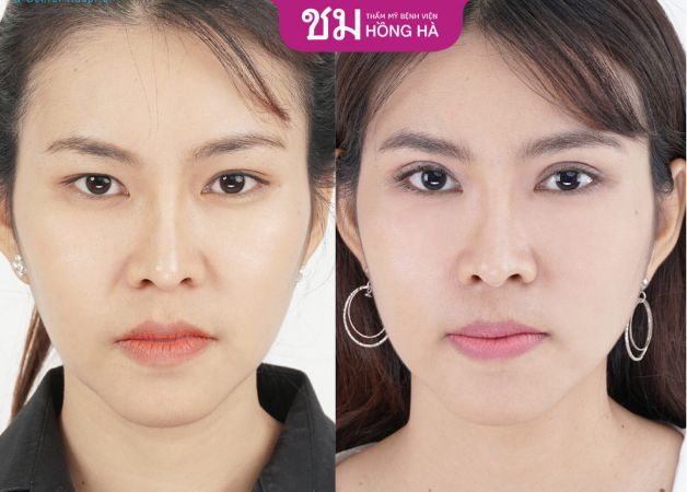 Sự khác biệt rất lớn ở vị trí đôi mắt trước và sau cắt mí