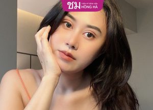 Cắt mí bao lâu thì lành – 4 Yếu tố ảnh hưởng