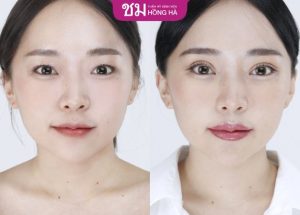 Cắt mí Thai Eyelid – Sở hữu mắt 2 mí to tròn thu hút ánh nhìn