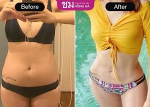 Hút mỡ bụng toàn phần – Giải pháp lấy lại vòng eo con kiến nhanh chóng