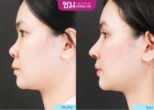 Nâng mũi cấu trúc Thai Shape – Bí quyết mũi đẹp chuẩn Thái