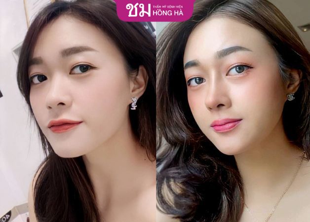 Hô biến chiếc mũi cao thanh thoát chuẩn Thái