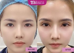 Tạo hình mí mắt – Giải pháp hoàn hảo cho đôi mắt không tuổi