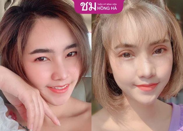 Nhấn mí có đau không? Trong quá trình thực hiện không gây đau đớn