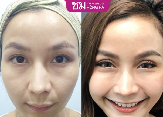 Tay nghề bác sĩ ảnh hưởng lớn đến mức độ sưng đau khi nhấn mí