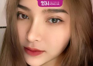 Thẩm mỹ BV Hồng Hà- Địa chỉ nhấn mí uy tín tại Hà Nội