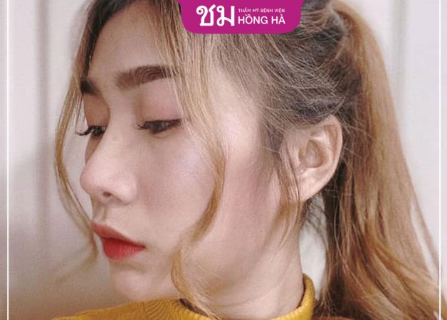 Thẩm mỹ nâng mũi bọc sụn không thể đạt được vĩnh viễn