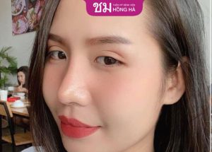 Cập nhật bảng giá nâng mũi bọc sụn mới nhất