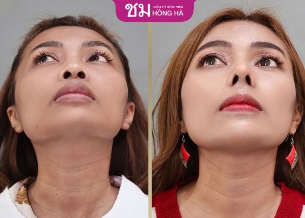Thẩm mỹ cắt cánh mũi có thể tồn tại vĩnh viễn