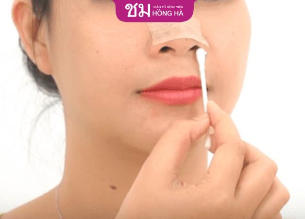 Nên vệ sinh cánh mũi đúng cách sau khi thẩm mỹ thu gọn cánh mũi