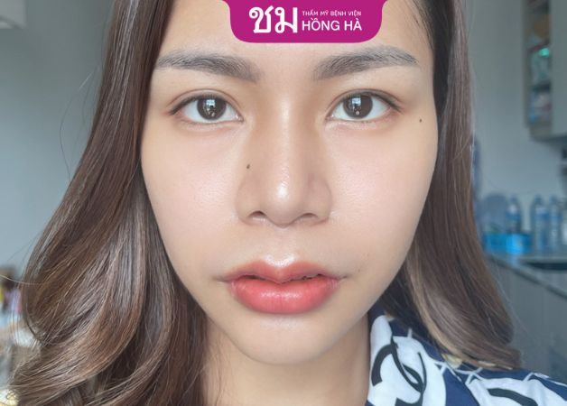 Khách hàng review tích cực về dịch vụ cắt mí tại Hồng Hà