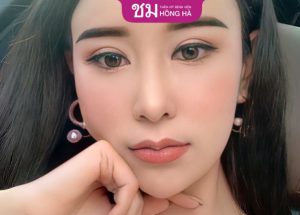 Cắt mí kiêng ăn gì? 3 lưu ý quan trọng để vết thương nhanh lành