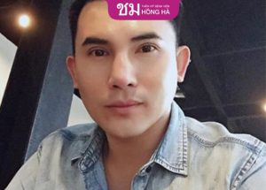 Cắt mí nam: Sự khác biệt giữa cắt mí nam so với nữ