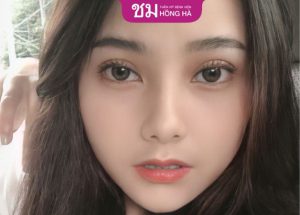 Cắt mí sau 6 tháng: Mí mắt lành hẳn, đạt vẻ đẹp tự nhiên thu hút