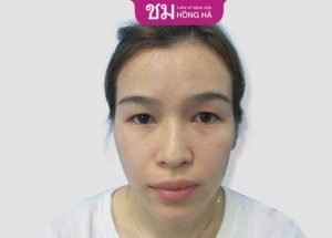 10 Cách chữa sụp mí mắt không phẫu thuật hiệu quả ngay tại nhà