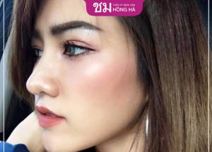 Cập nhật giá nâng mũi S Line- 4 yếu tố ảnh hưởng đến giá dịch vụ