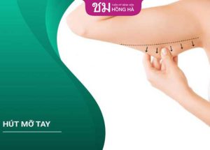 Hút mỡ bắp tay bao lâu lành – Bác sĩ Thẩm mỹ Hồng Hà giải đáp