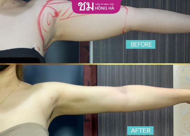 Đôi tay thon gọn sau khi hút mỡ thành công