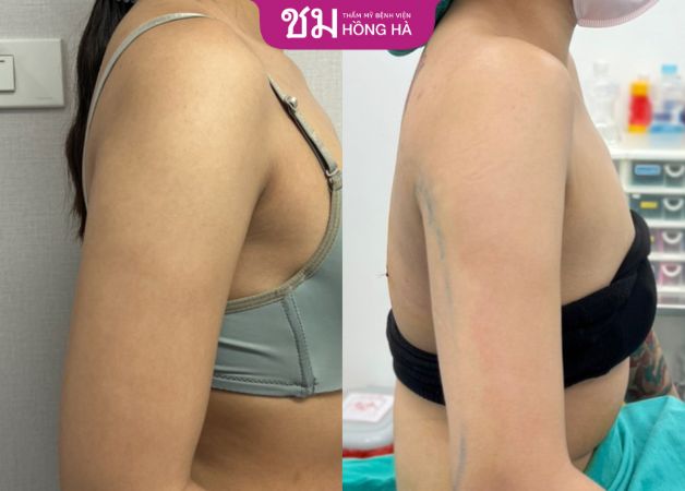 Hình ảnh khách hàng sau hút mỡ bắp tay