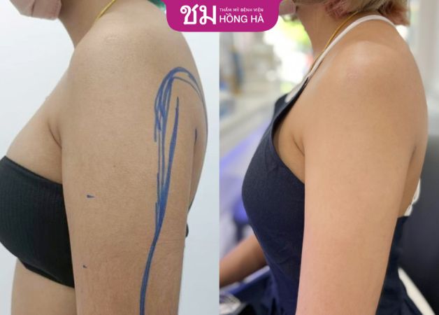 Bắp tay to và nhiều mỡ thừa trở nên thon gọn sau hút mỡ