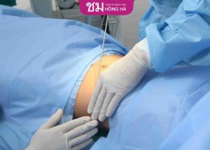 Hút mỡ bụng dưới – Giải pháp hoàn hảo xóa tan 99% mỡ thừa