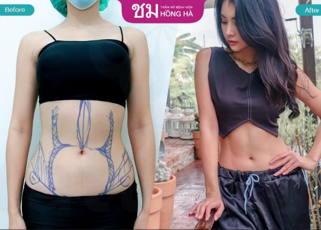 Khách hàng thành công giảm mỡ bụng với công nghệ hút mỡ chuẩn Thái