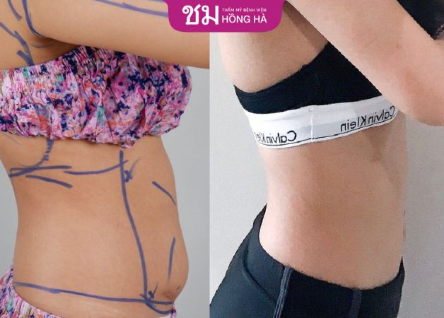 Hình ảnh trước - sau của khách hàng khi hút mỡ bụng