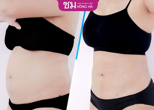 Mỡ thừa vùng bụng được loại bỏ triệt để và vùng bụng trở nên săn chắc