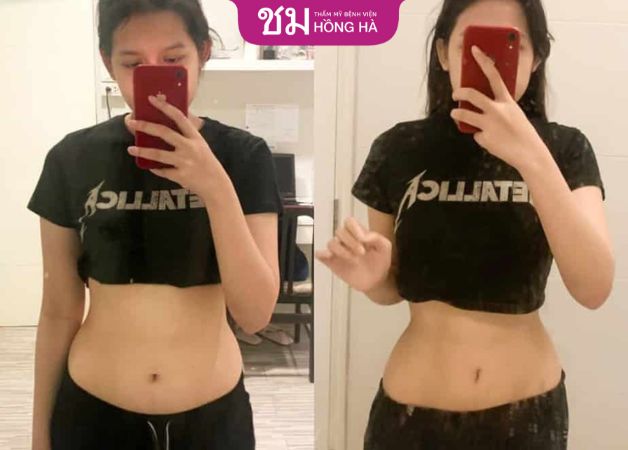 Khách hàng sở hữu vùng bụng thon gọn