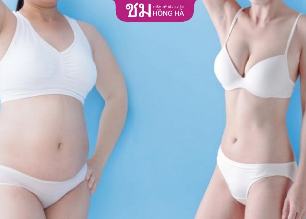 Nên thực hiện hút mỡ eo để lấy lại đường nét quyến rũ