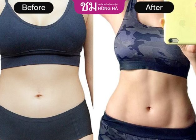 Lấy lại vóc dáng thon gọn sau khi hút mỡ vùng eo
