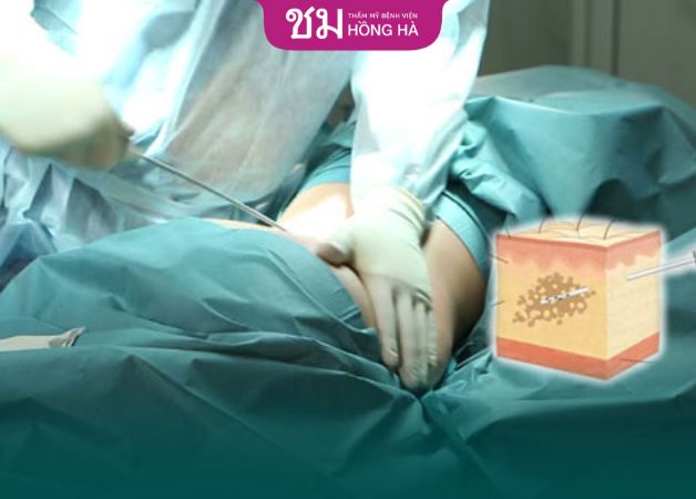 Hút mỡ vùng eo với chi phí tốt tại Thẩm mỹ Bệnh viện Hồng Hà