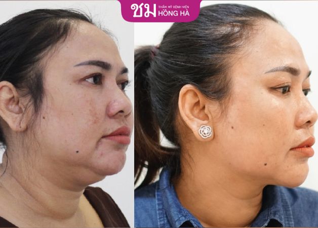 Sự thay đổi của khách hàng Hạ Vi sau hút mỡ cằm