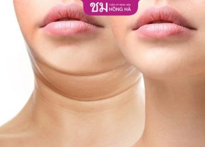 Hút mỡ nọng cằm: Xóa sổ 95% mỡ thừa chỉ sau 30 phút thực hiện