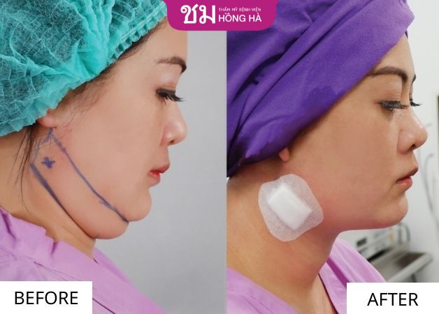 Khách hàng xóa bỏ nọng cằm sau khi hút mỡ theo công nghệ chuẩn Thái