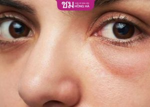 Lấy mỡ bọng mắt dưới – Địa chỉ thẩm mỹ mắt uy tín tại Việt Nam