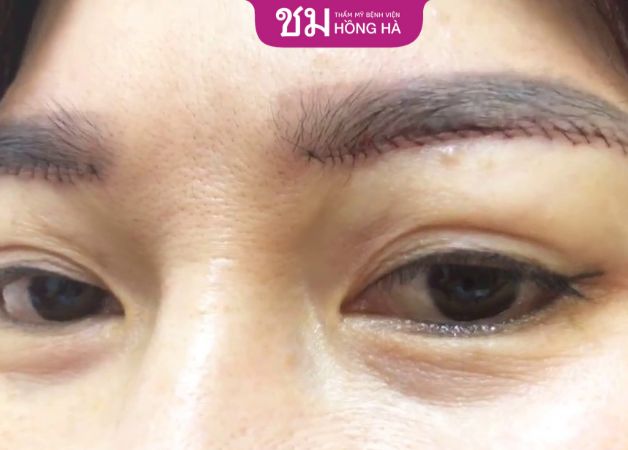 Nguyên nhân khiến nâng cung mày hỏng là do cách chăm sóc